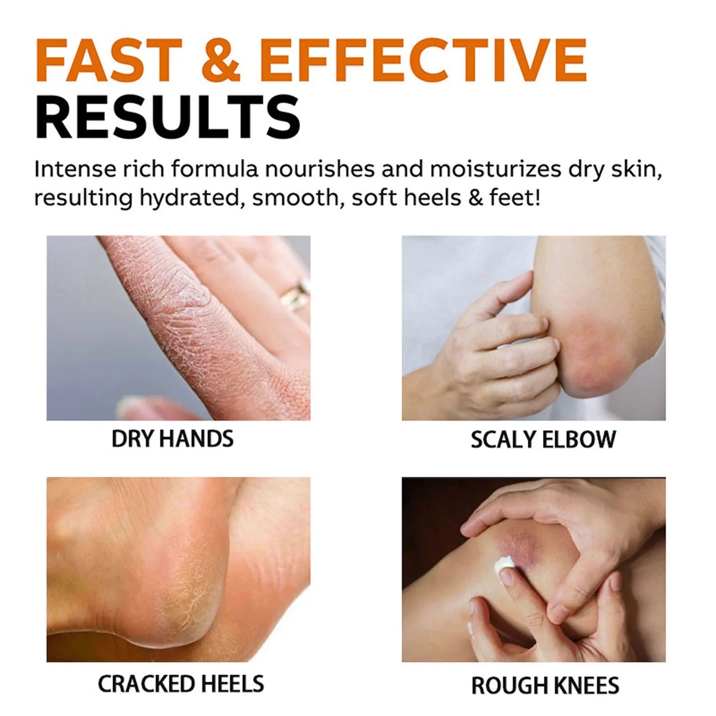 Urea Foot Cream,Urea Cream for Feet,Urea Foot Cream 40 Percent Foot Cream for Cracked Heels and Dry Skin, Deep Moisturising, Callus Remover 100G